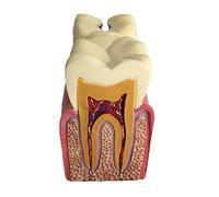Yunmeryker Caries Modello Comparativo Dentiera Studio Malattie Orale Sezione Trasparente Strumento Didattico Materiale Resina Adatto per Formazione
