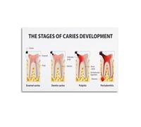 YZWRWRMKTB Understanding Tooth Decay Poster - Visual Guide to Dental Caries Development Stages, Educational Wall Decor for Clinic(Unframed,12x18inch(30x45cm))