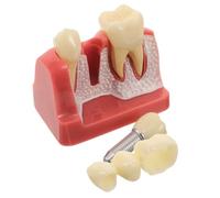 Zerodeko Modello di confronto delle malattie dentali, strumento per | Strumento dimostrativo per , modello di carie artificiale 4 volte più complesso, strumento didattico per la diagnosi delle