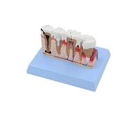 zorfar Dente Dentale Patologia Modello Anatomico Scienze Mediche Risorse Didattiche Dropshipping